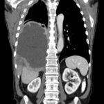 TC di mesotelioma pleurico (vasta massa che schiaccia il polmone destro) - tratto da Wikipedia.org